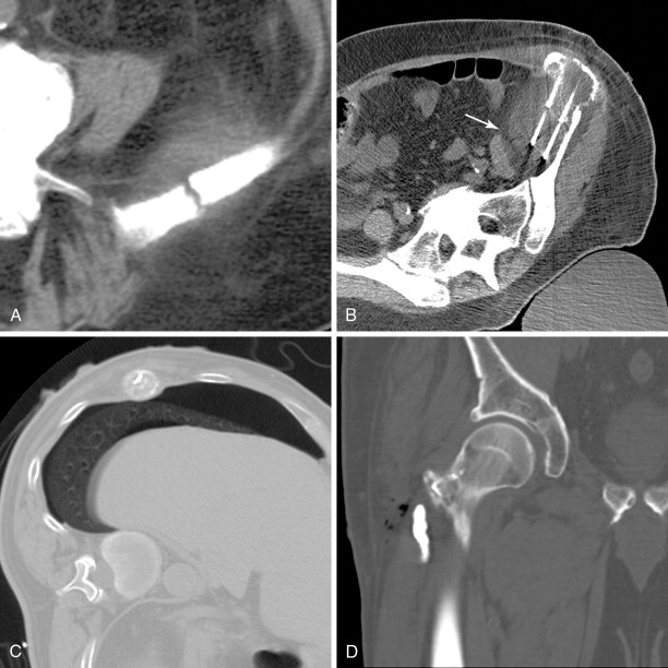 Ablation Of Musculoskeletal Metastatic Lesions Including Cementoplasty ...