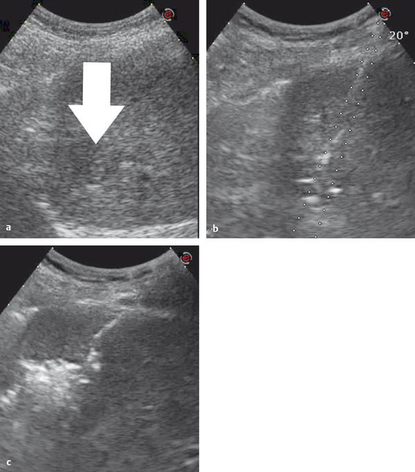 4 Hepatocellular Carcinoma: Ablation | Oncohema Key