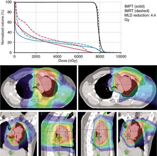 Principles Of Intensity-modulated Proton Therapy Treatment Planning ...