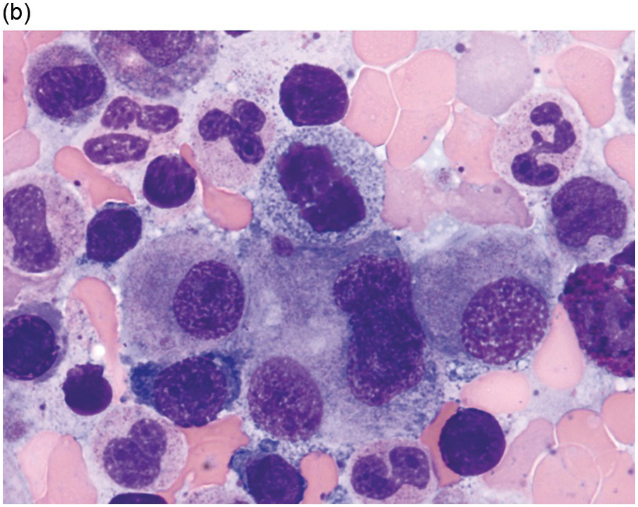 Chapter 11 – Myelodysplastic/Myeloproliferative Neoplasms | Oncohema Key