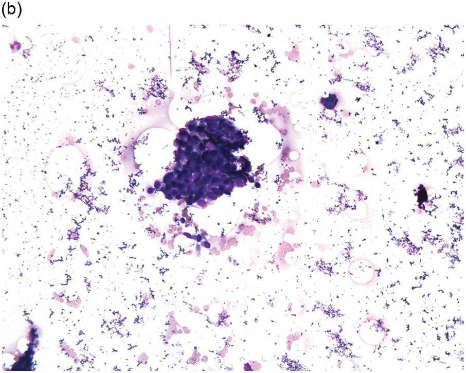 Chapter 17 – Metastatic Lesions | Oncohema Key