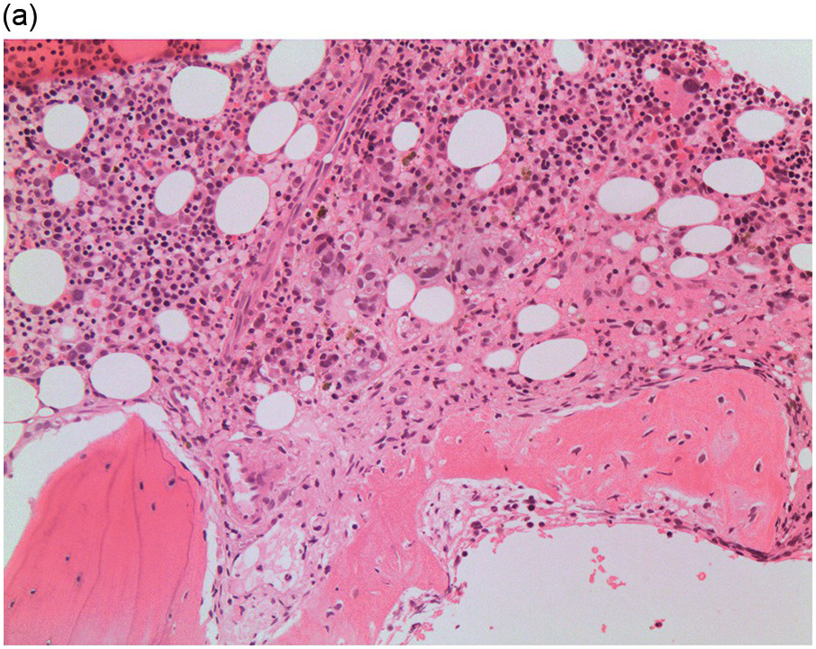 Chapter 17 – Metastatic Lesions | Oncohema Key