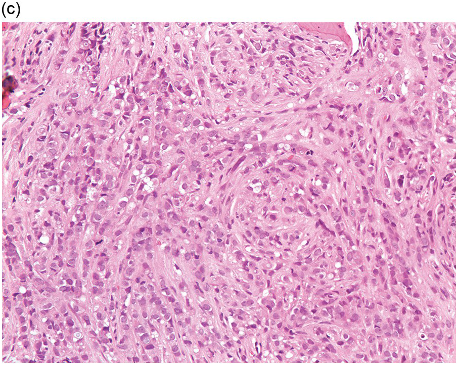 Chapter 17 – Metastatic Lesions | Oncohema Key