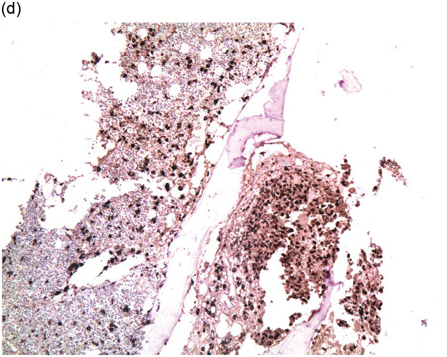 Chapter 17 – Metastatic Lesions | Oncohema Key