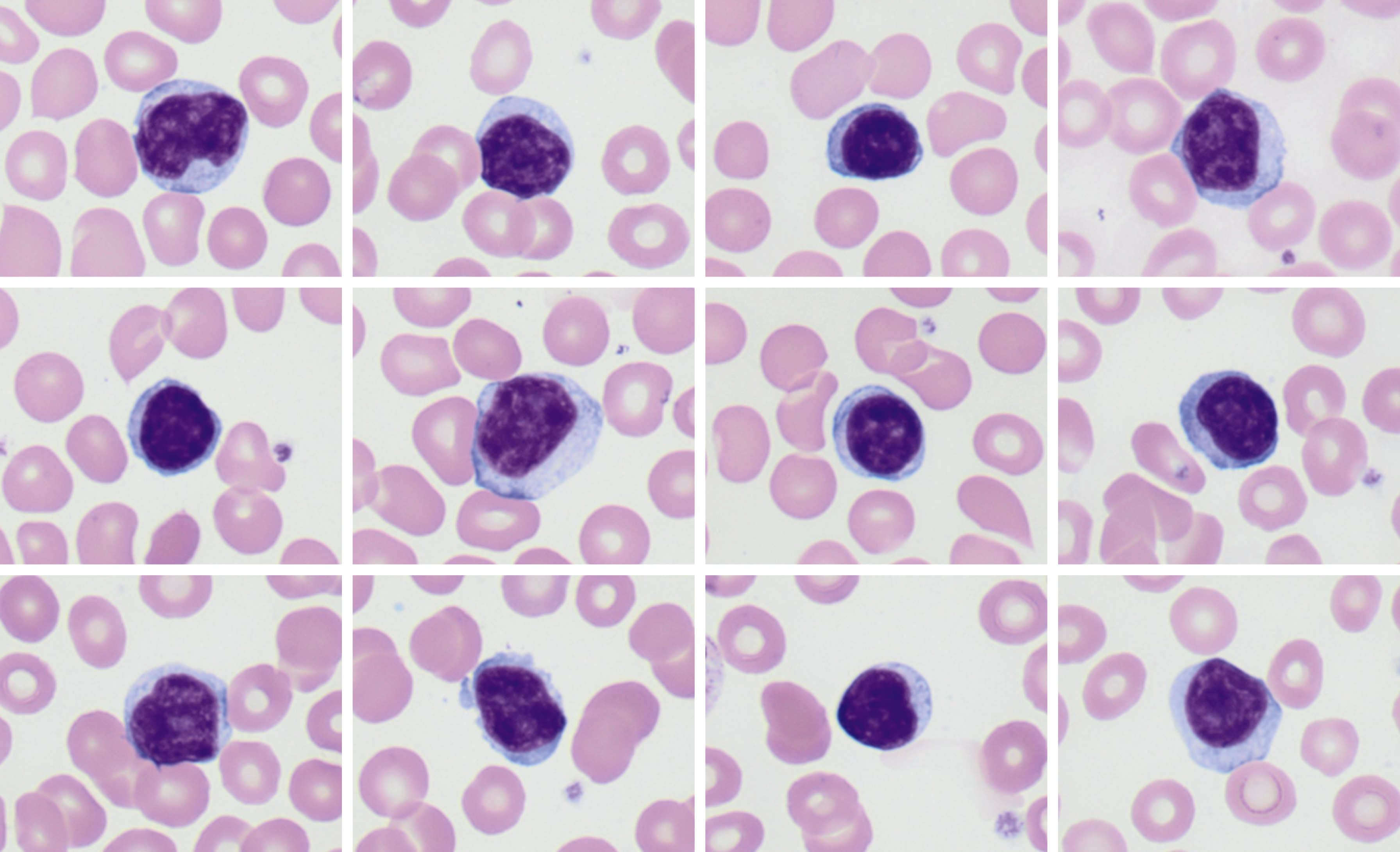 B-Cell Chronic Lymphoid Leukemias | Oncohema Key