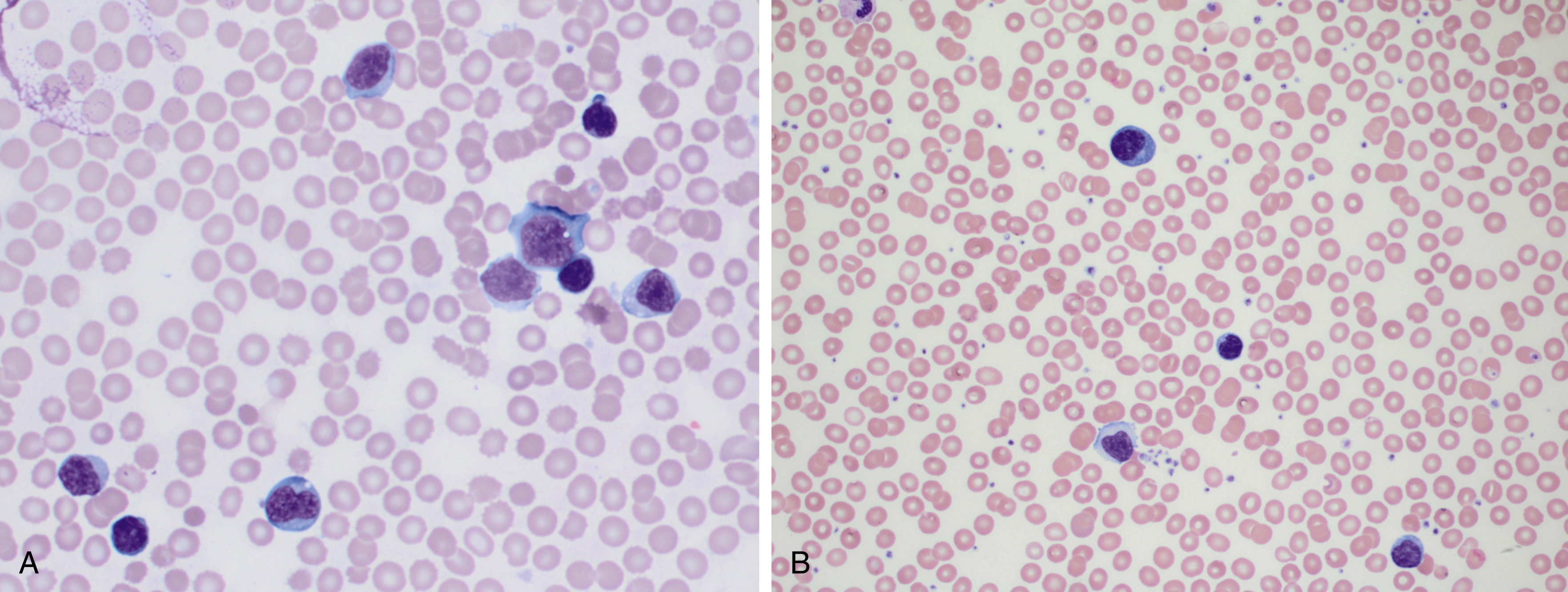 B-Cell Chronic Lymphoid Leukemias | Oncohema Key