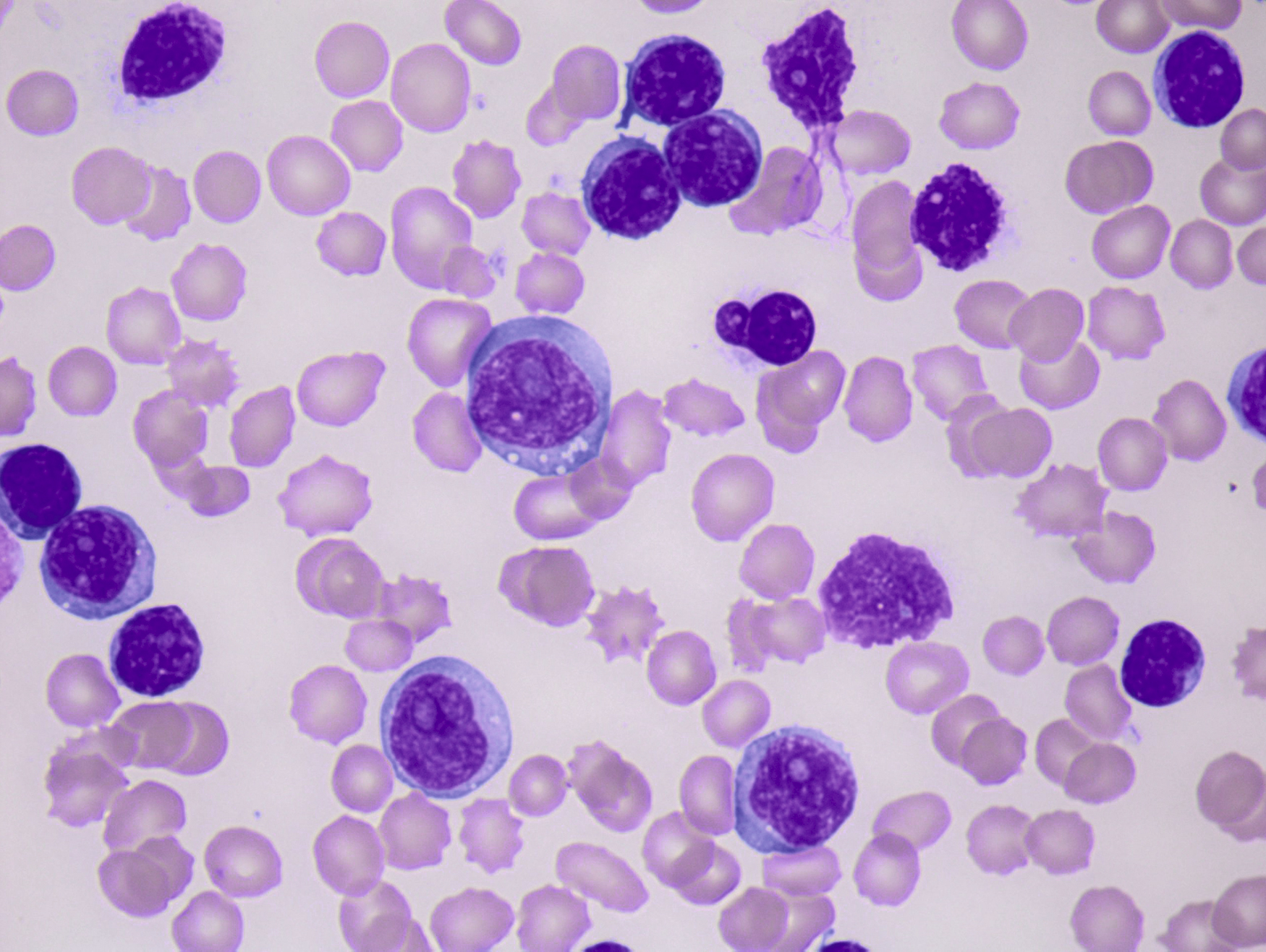 B-Cell Chronic Lymphoid Leukemias | Oncohema Key