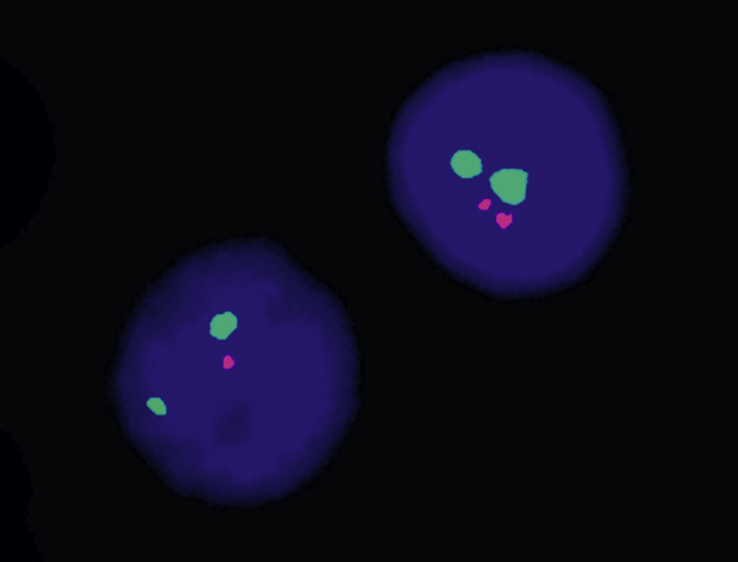 B-Cell Chronic Lymphoid Leukemias | Oncohema Key