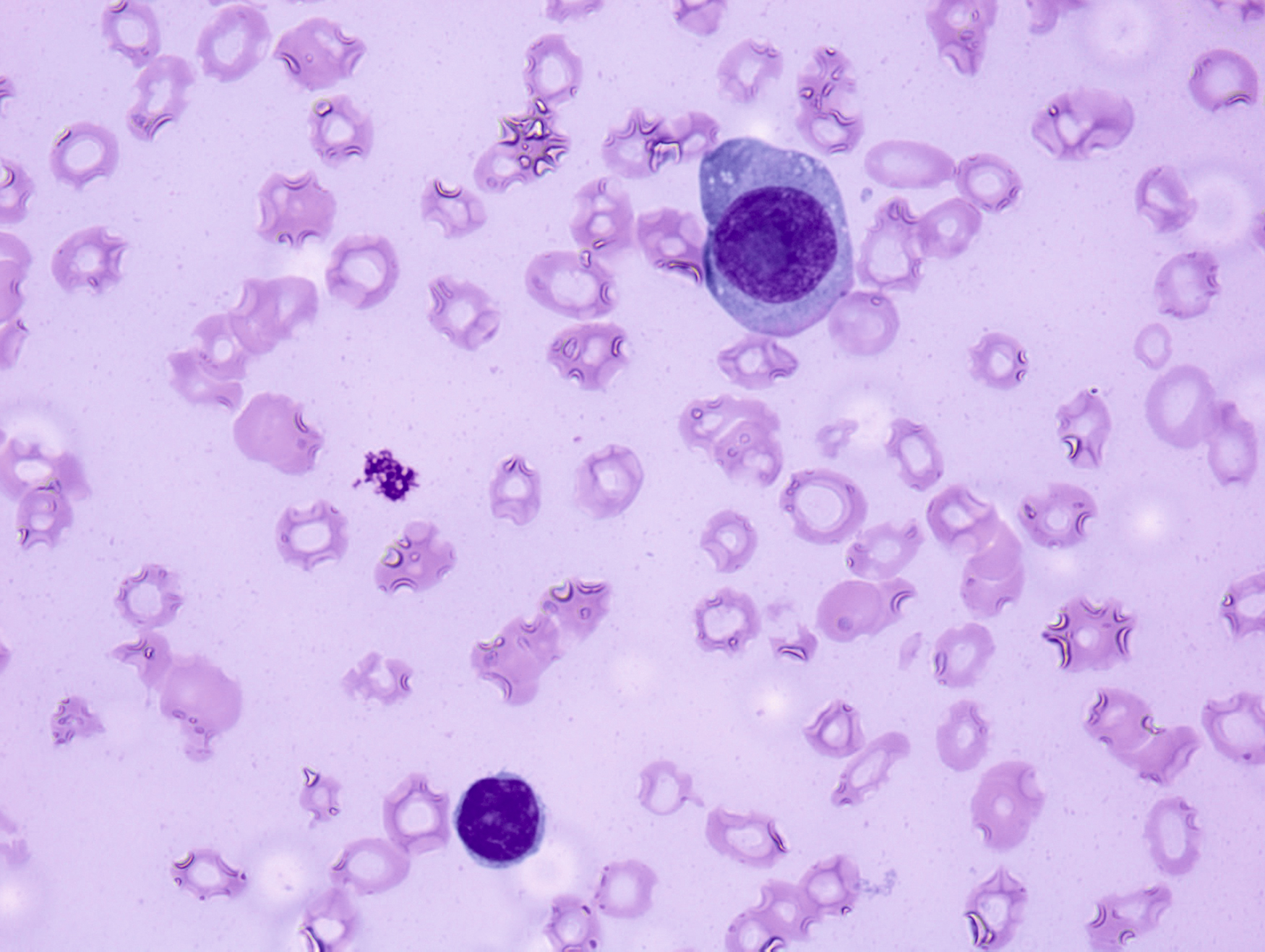 B-Cell Chronic Lymphoid Leukemias | Oncohema Key