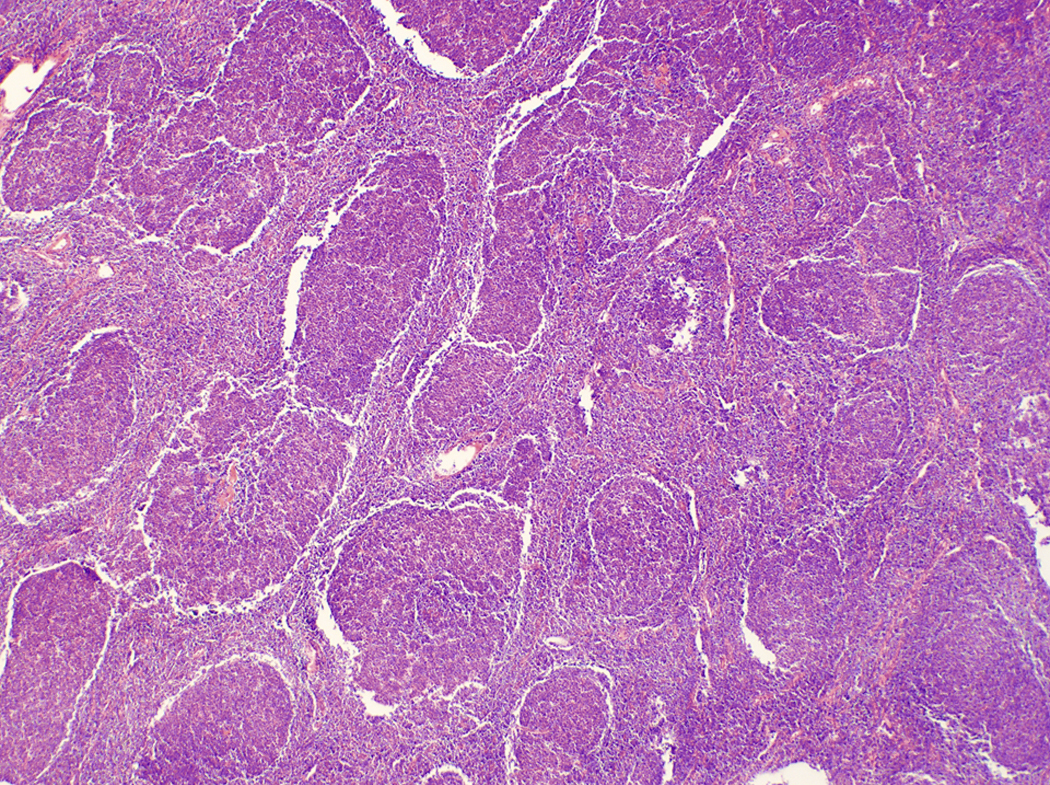 Indolent And Aggressive B-Cell Lymphoma | Oncohema Key