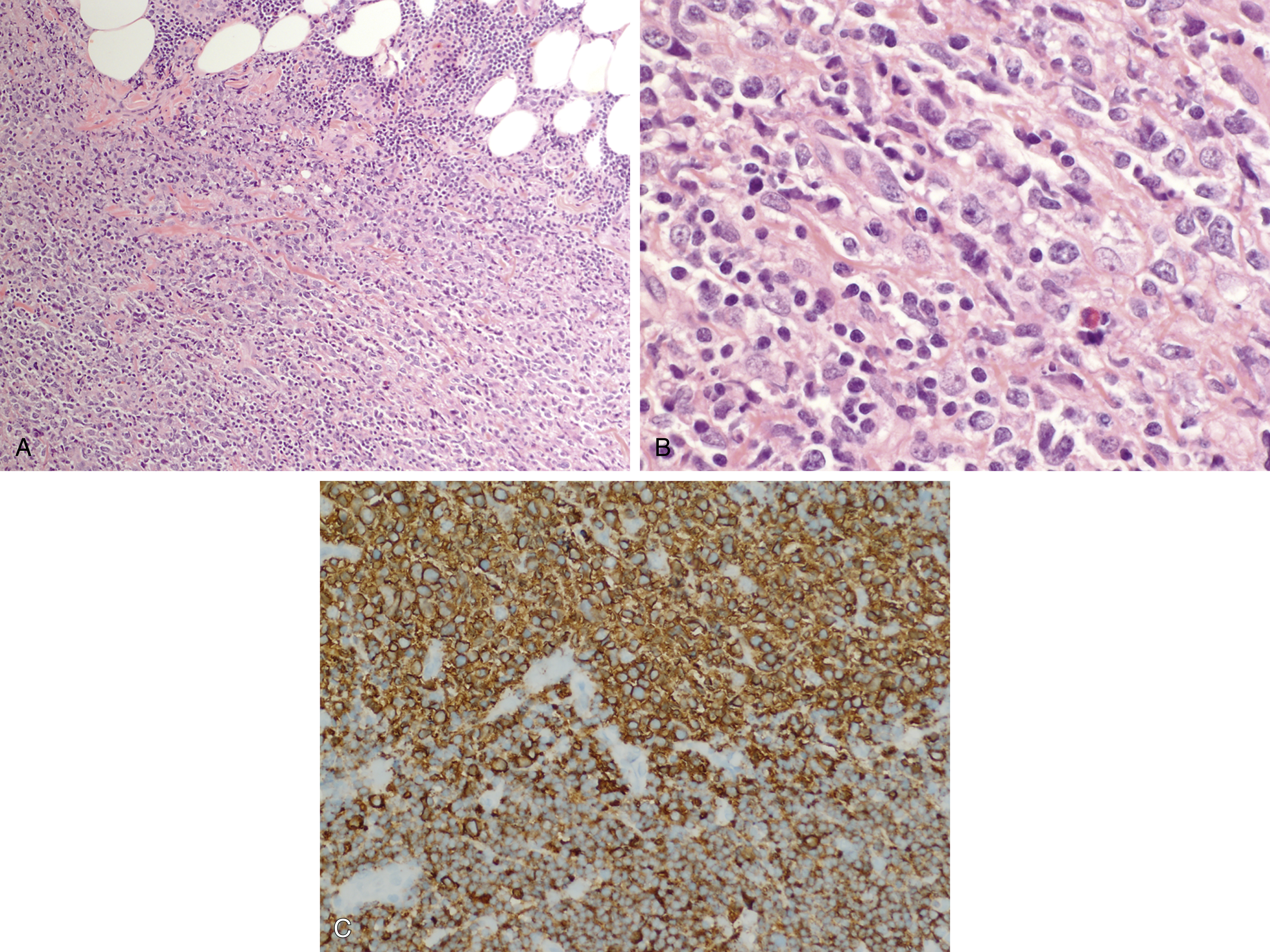 Indolent And Aggressive B-Cell Lymphoma | Oncohema Key