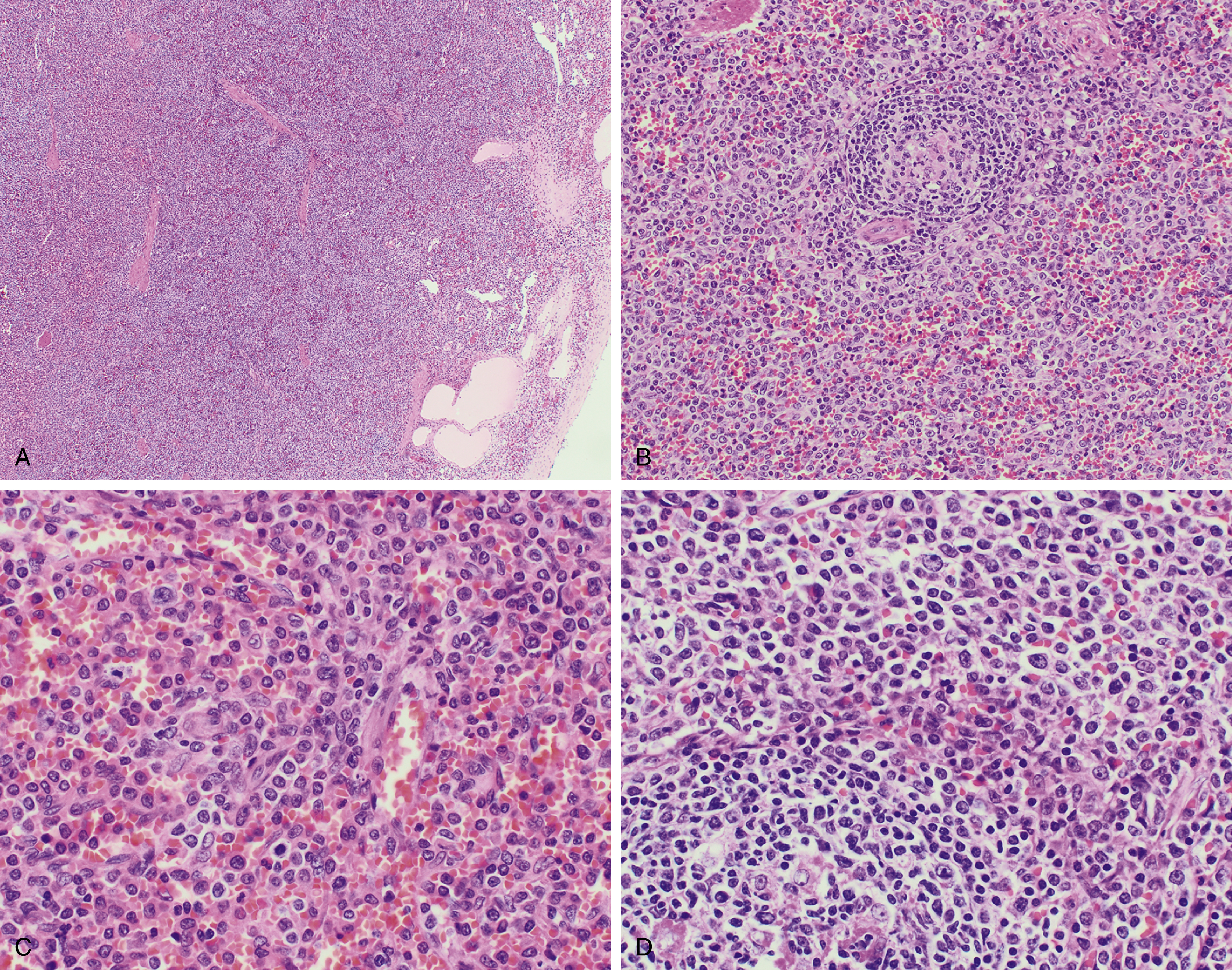 Indolent And Aggressive B-Cell Lymphoma | Oncohema Key