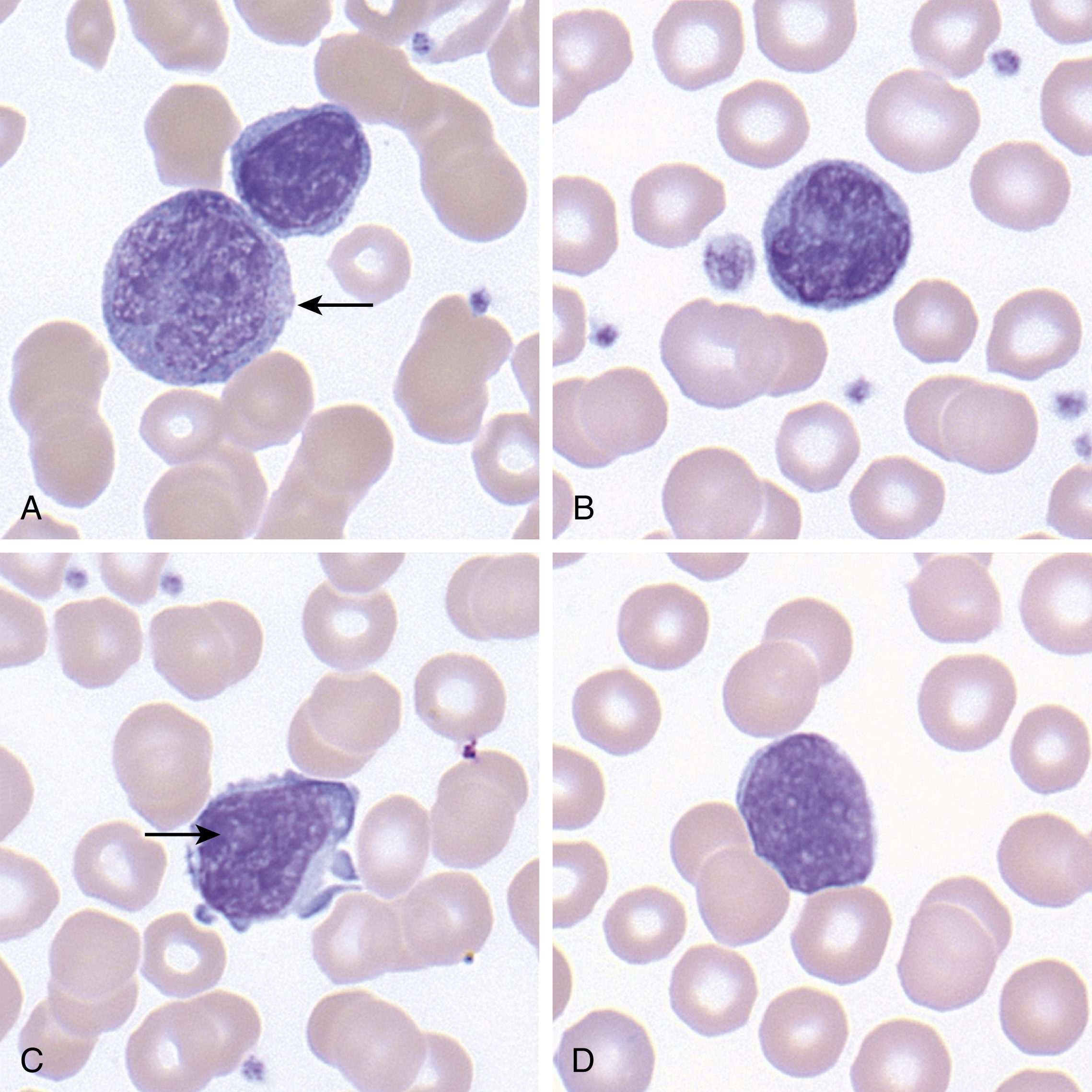 Indolent And Aggressive Mature T-Cell And Natural Killer–Cell Lymphomas ...