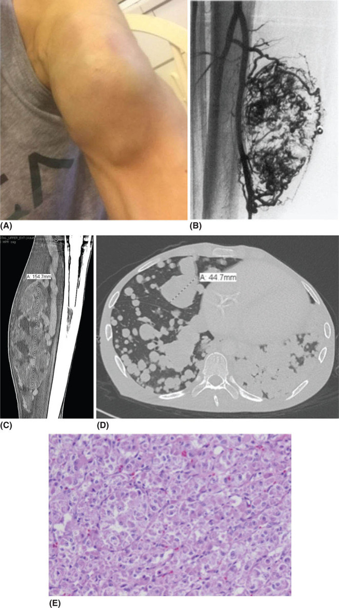 Alveolar Soft Part Sarcoma | Oncohema Key