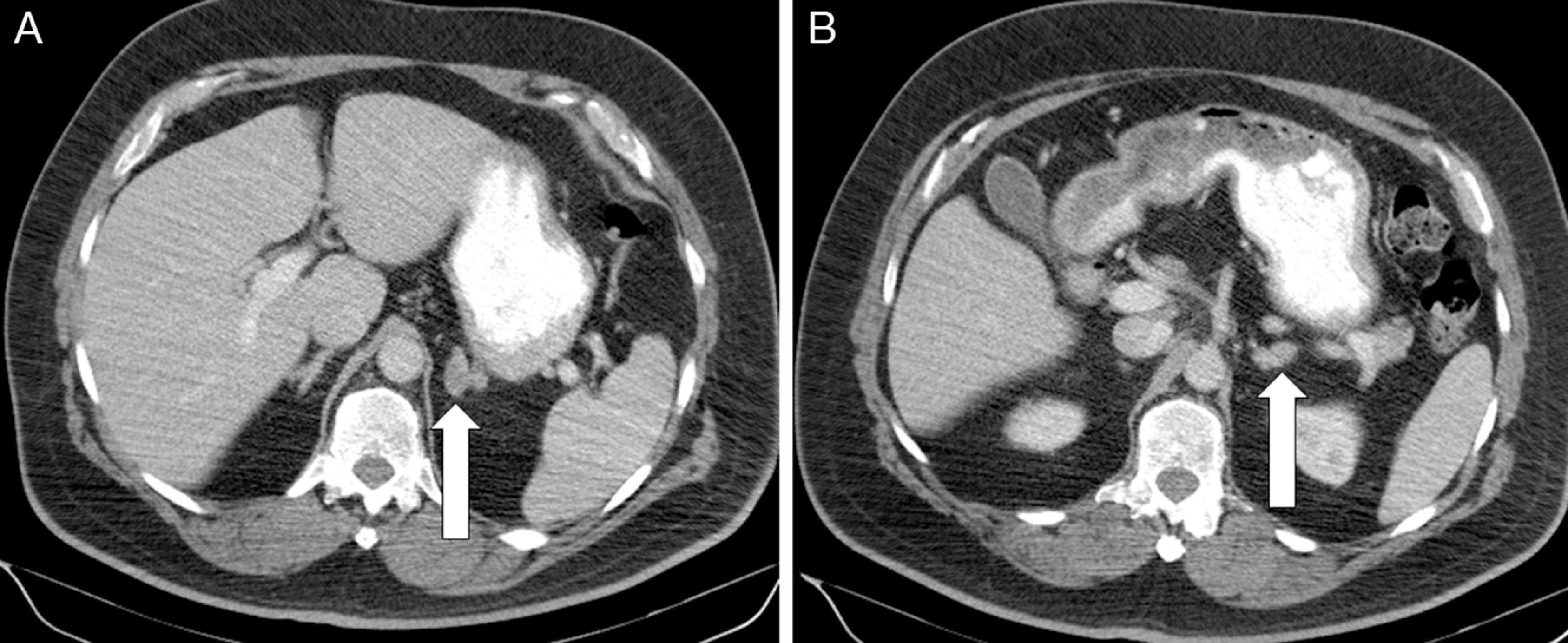 Primary Aldosteronism Caused By Unilateral Adrenal Hyperplasia ...