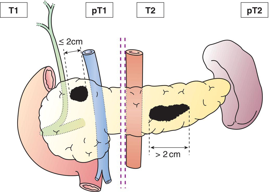 NEUROENDOCRINE TUMOURS OF THE PANCREAS | Oncohema Key